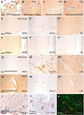 Complement activation and increased anaphylatoxin receptor expression are associated with cortical grey matter lesions and the compartmentalised inflammatory response of multiple sclerosis
